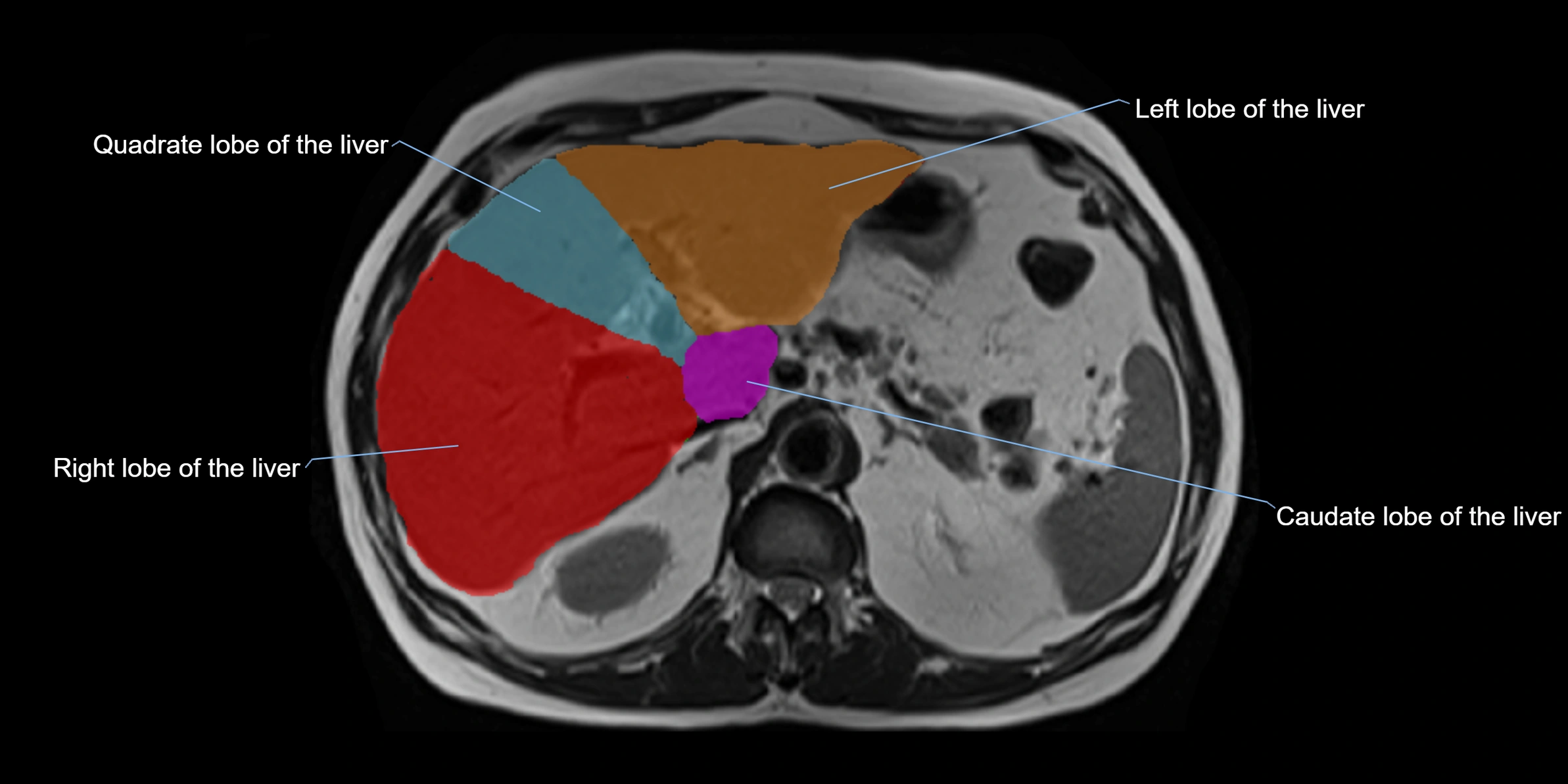 MRI liver lobe axial cross sectional 3T radiology  image-img-00001-00014.webp